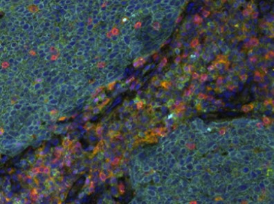 cancer cells