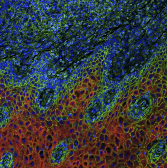 Cancer cells, shown in red, prevent the presentation of antigens, shown in green, and evade T cells, which kill cancer cells as a part of the body’s immune system. Image courtesy of Lexi Vu in the Pyeon lab at Michigan State University.