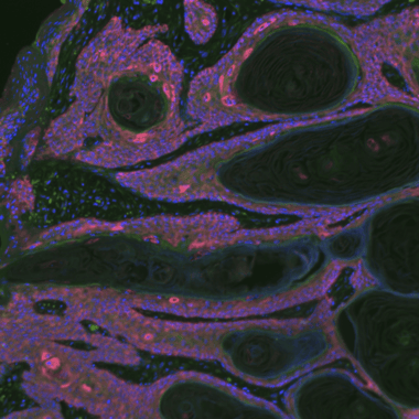 This image shows immunofluorescence staining of K14+ epithelial cells (red) and CD8+ cells (green)