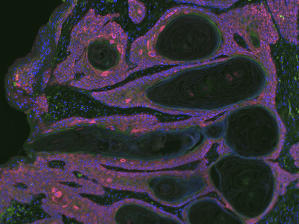 This image shows immunofluorescence staining of K14+ epithelial cells (red) and CD8+ cells (green)